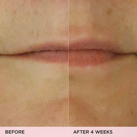 The Kissu Lip Treatment